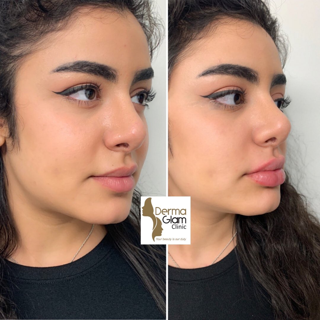 dermaglam's tweet photo. Lip Filler 💉👄
1 ml Restylane Kysse
#lipfiller
#torontolipfiller 
#torontomedicalspa https://t.co/v2iS9vBhjH