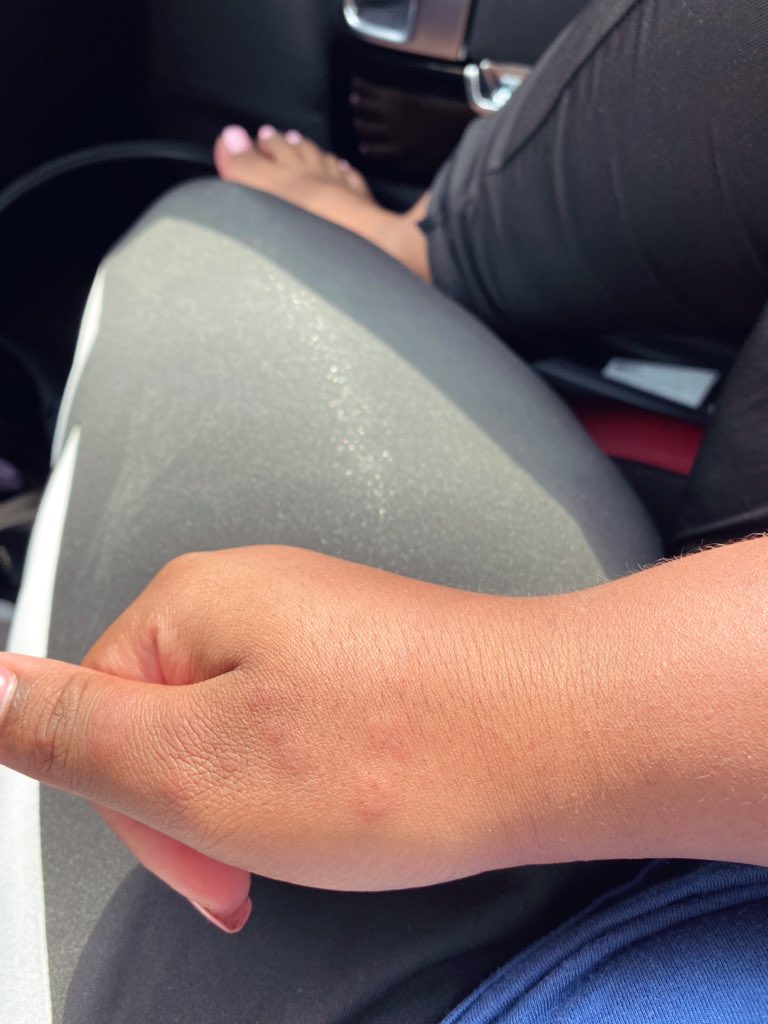 Still having the random swelling that primarily affects my hands for some reason :/ I got covid end of May, it’s August. I am still not recovered & my quality of life has diminished drastically. Before you go out to that party, the beach, or don’t wear your mask, remember this.