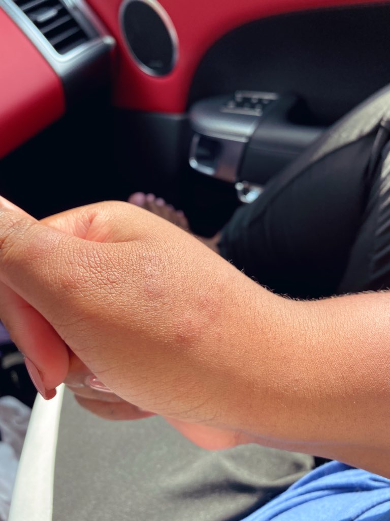 Still having the random swelling that primarily affects my hands for some reason :/ I got covid end of May, it’s August. I am still not recovered & my quality of life has diminished drastically. Before you go out to that party, the beach, or don’t wear your mask, remember this.