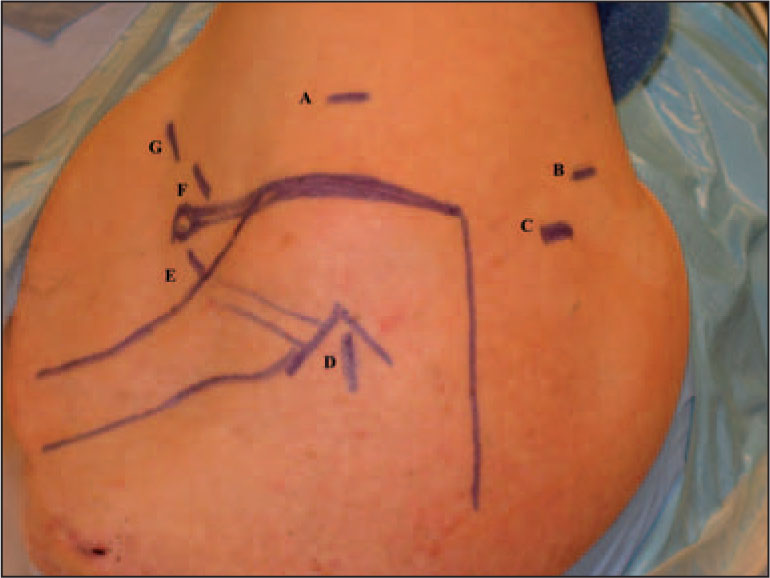orthobullets's tweet photo. Axillary nerve leaves the axilla through the quadrangular space &amp; winds around humerus on deep surface of the deltoid muscle &amp; passes ~7 cm below tip of acromion. Nerve injury may occur when posterior portals during shoulder arthroscopy are made inferior. https://t.co/S5vaXR1zCc https://t.co/NQdjpPbwAP
