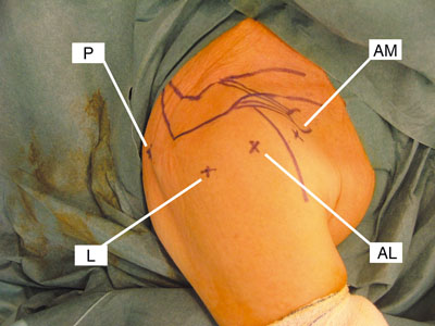 orthobullets's tweet photo. Axillary nerve leaves the axilla through the quadrangular space &amp; winds around humerus on deep surface of the deltoid muscle &amp; passes ~7 cm below tip of acromion. Nerve injury may occur when posterior portals during shoulder arthroscopy are made inferior. https://t.co/S5vaXR1zCc https://t.co/NQdjpPbwAP