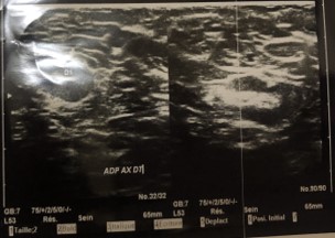 munaganuri08's tweet photo. Granulomatory Mastitis: A histological benign lesion with a malignant Radioclinical profile: About 3 Cases

https://t.co/2xlgiKpMVA https://t.co/cVTt3JZovQ