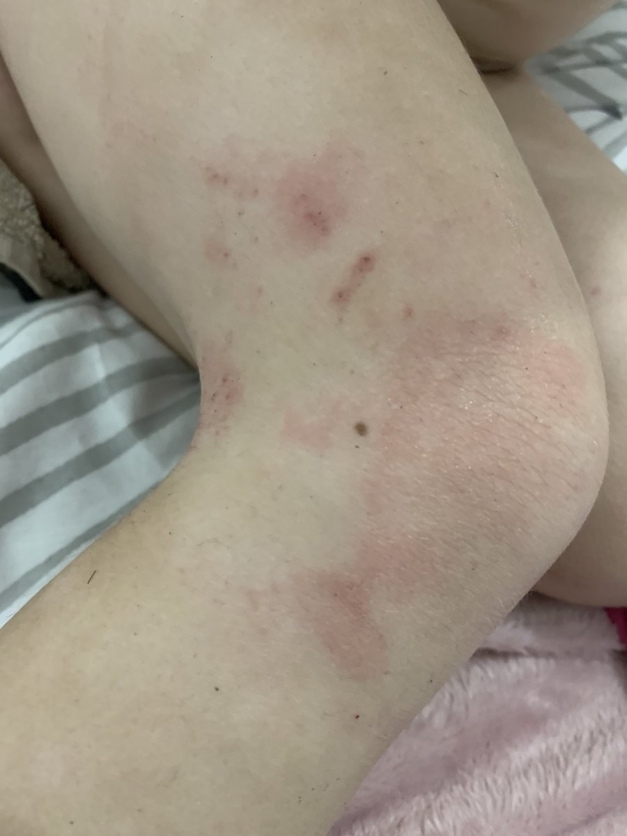 lucykrater's tweet photo. Anyone able to help ? My daughter suffers with what her Pediatrician says is excema . She has diary , egg & milk allergies. Tried all things suggested for skin but she’s getting no relief #help #excema #allergies https://t.co/mQ5V5WD4M6