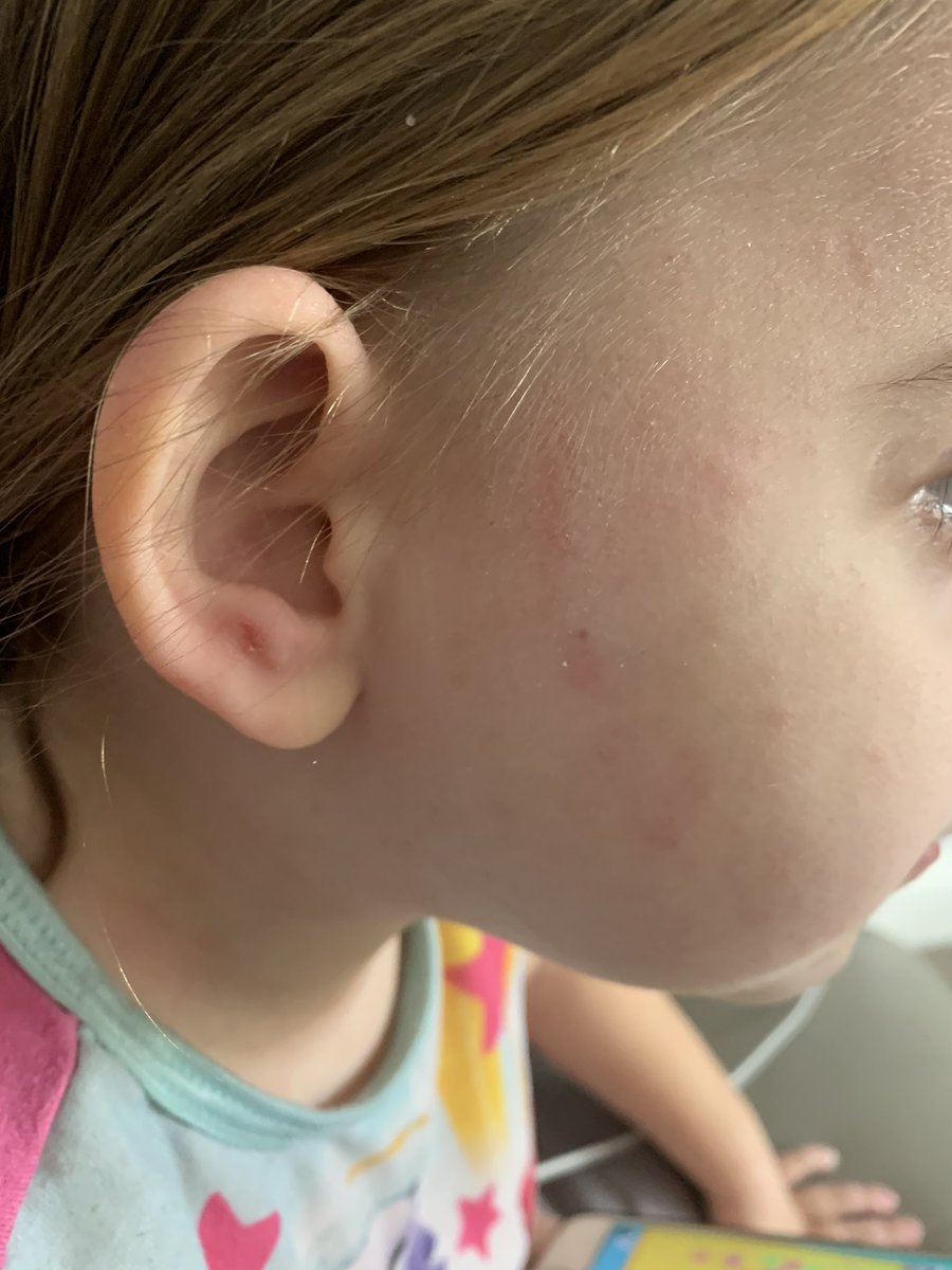 lucykrater's tweet photo. Anyone able to help ? My daughter suffers with what her Pediatrician says is excema . She has diary , egg & milk allergies. Tried all things suggested for skin but she’s getting no relief #help #excema #allergies https://t.co/mQ5V5WD4M6