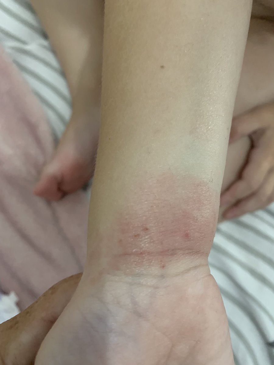 lucykrater's tweet photo. Anyone able to help ? My daughter suffers with what her Pediatrician says is excema . She has diary , egg & milk allergies. Tried all things suggested for skin but she’s getting no relief #help #excema #allergies https://t.co/mQ5V5WD4M6