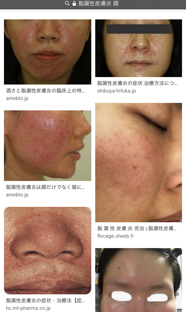 皮膚 性 脂 顔 漏 炎
