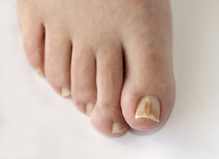 FootCarrollton's tweet photo. Don't stare at that fungal toenail any longer. We're here to help by offering #KeryFlex and restoring the appearance of your toenails. #CarrolltonFootCenter https://t.co/qn0TaDnFtX https://t.co/BsTeJKzRTl