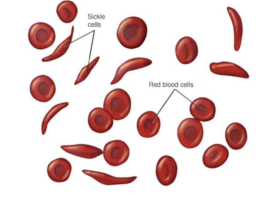 Another case appeared in the literature in 1910, followed by one in 1915 then 1922. The medical community began to learn more. It was not until 1949 that Linus Pauling found that the sickling of RBCs was due to abnormal hemoglobin. 7/n