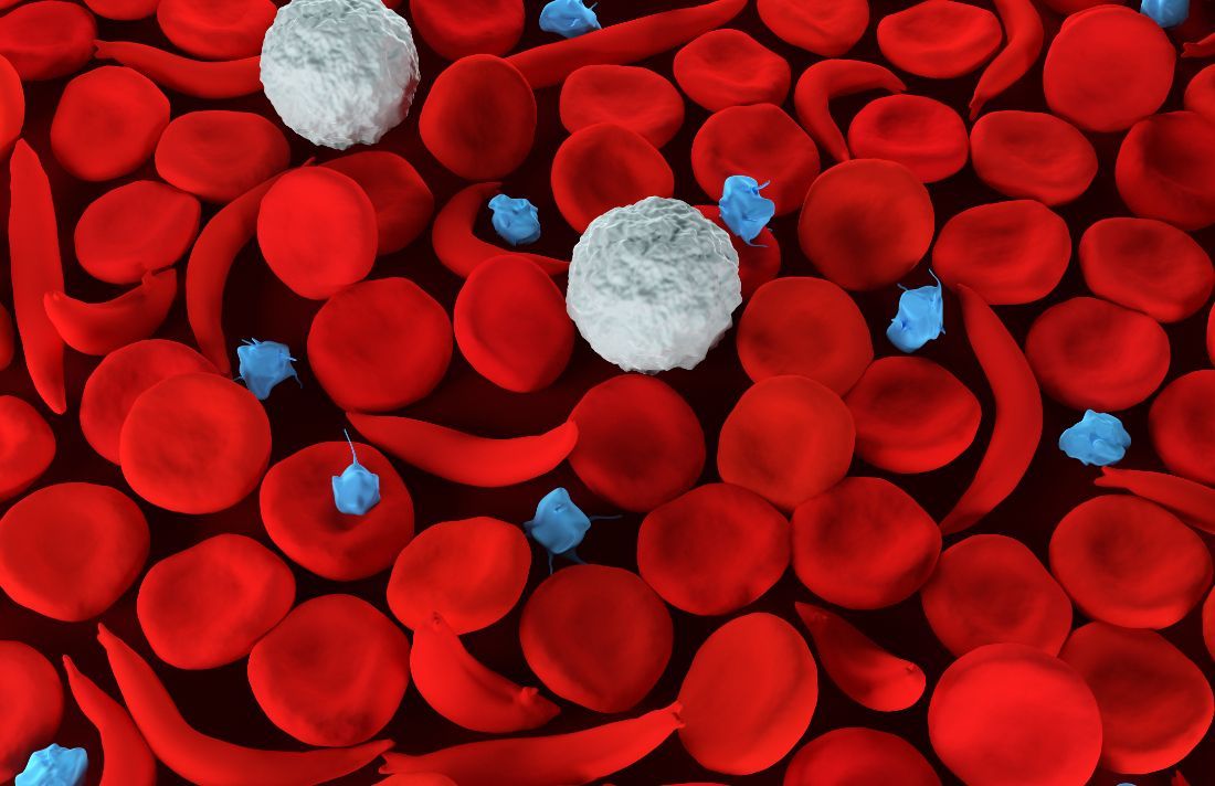 This is promising news about cannabis and sickle cell disease; the most common inherited blood disorder in the United States. bit.ly/3fYdQyz