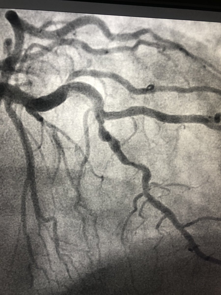 rzakir12's tweet photo. Been very impressed with the flex tip viper wire . IVUS no-cross  , 2nd image no bias or straightening with flex tip. did glide assist to the lesion , spun on low with a good final result . @DrAmirKaki @KAlaswadMD @JayMathewsMD @matheenkhuddus @csi360 https://t.co/OSRzzPYzQ9