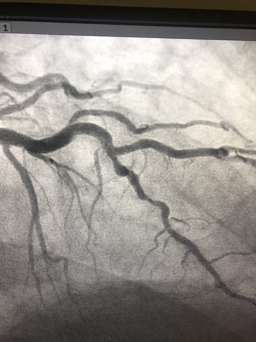 rzakir12's tweet photo. Been very impressed with the flex tip viper wire . IVUS no-cross  , 2nd image no bias or straightening with flex tip. did glide assist to the lesion , spun on low with a good final result . @DrAmirKaki @KAlaswadMD @JayMathewsMD @matheenkhuddus @csi360 https://t.co/OSRzzPYzQ9