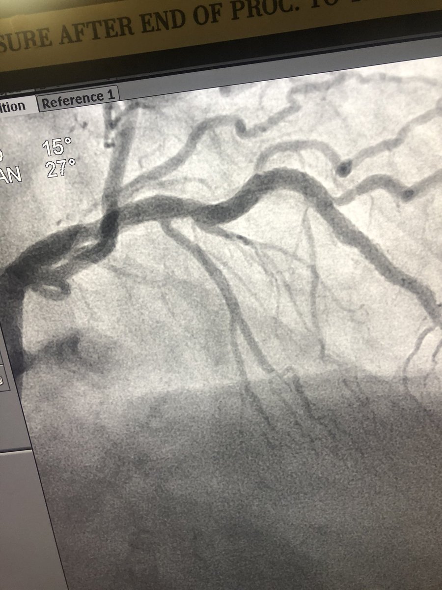 rzakir12's tweet photo. Been very impressed with the flex tip viper wire . IVUS no-cross  , 2nd image no bias or straightening with flex tip. did glide assist to the lesion , spun on low with a good final result . @DrAmirKaki @KAlaswadMD @JayMathewsMD @matheenkhuddus @csi360 https://t.co/OSRzzPYzQ9