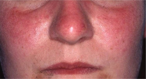 Imagen: El rostro de una persona con piel enrojecida a causa de la rosácea.