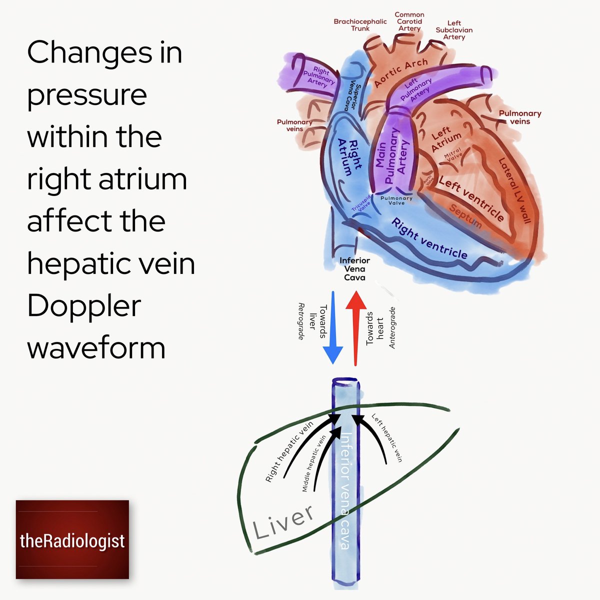 The dreaded hepatic vein Doppler waveform...