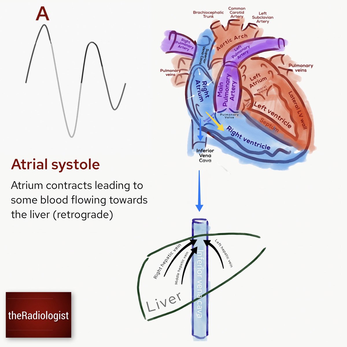The dreaded hepatic vein Doppler waveform...