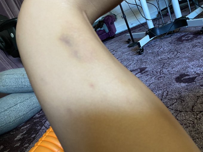 I’m still in awe that this is from a wasp sting and it’s day 4! How is it still itchy? https://t.co/