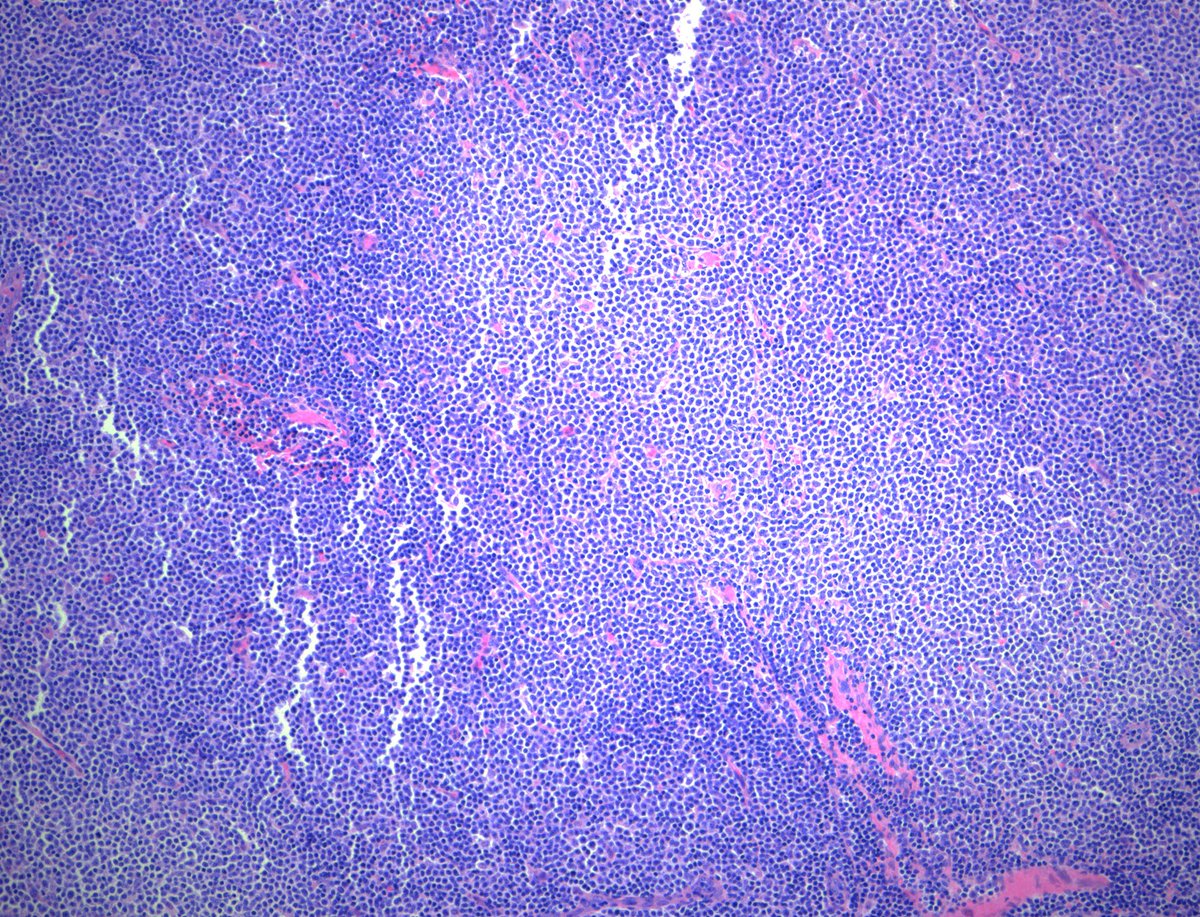 This week's #ucsfHCOW is a cervical lymph node bx from an elderly man who reports noticing enlarged axillary and cervical lymph nodes for the past several months. #hemepath #pathboards