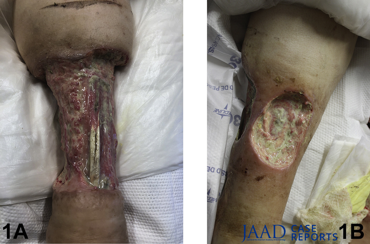 nonuremic calciphylaxis
