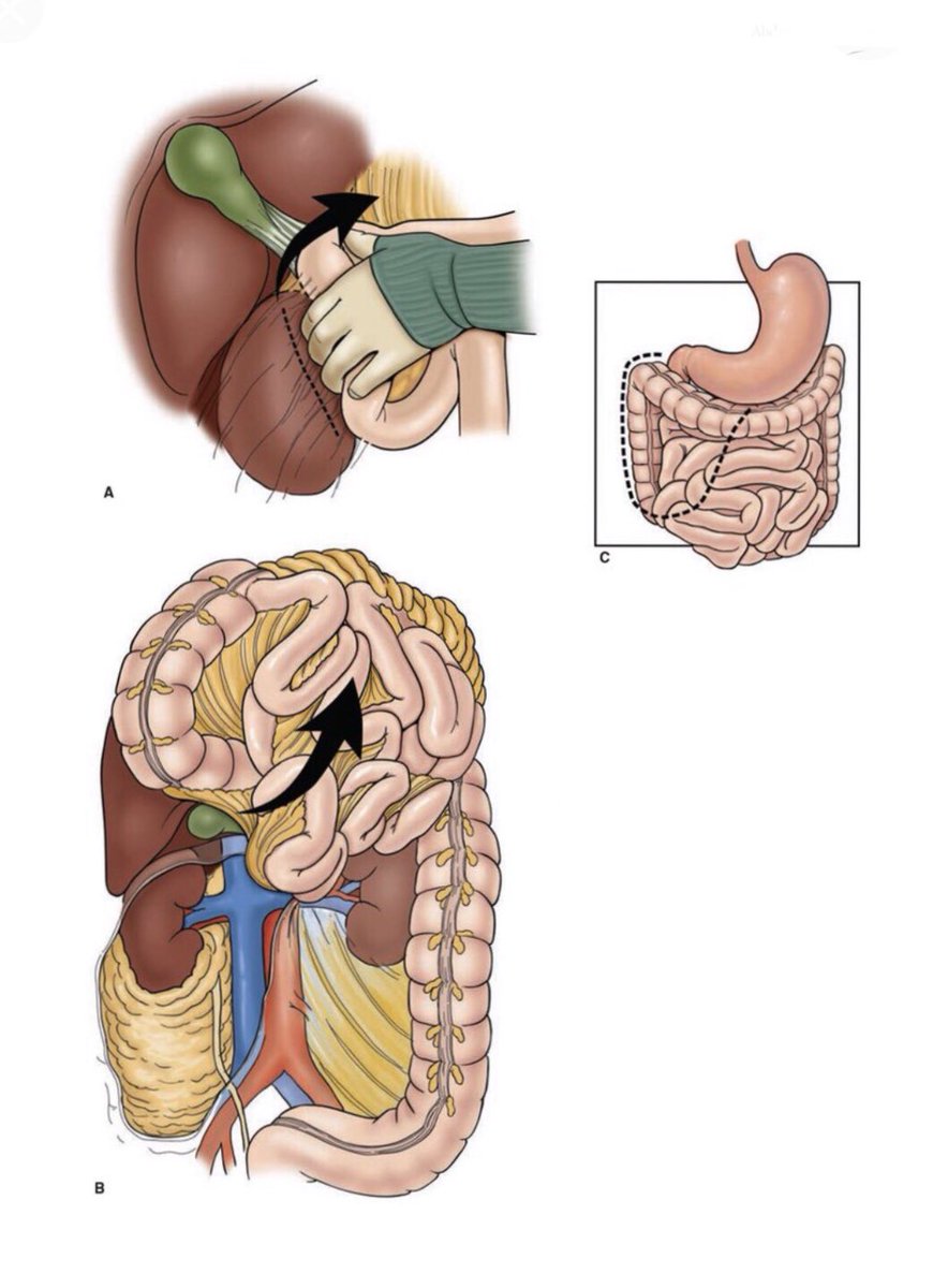 Kocher Maneuver Operative Technique. A Kocher Maneuver Reveals The SMA
