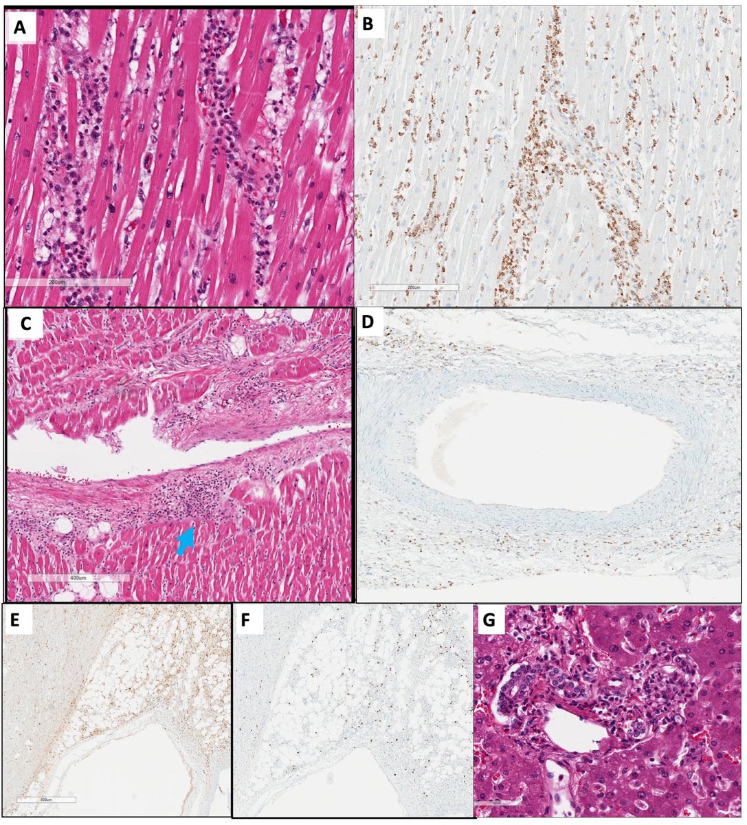 EricTopol's tweet photo. A 31-year-old African American woman, #SARSCoV2-positive, died from a heart arrhythmia and autopsy showed extensive heart endotheliitis and vasculitis, part of a multi-system inflammatory syndrome https://t.co/vpefmQc4FT @AnnalsofIM https://t.co/xLH55qxmA9