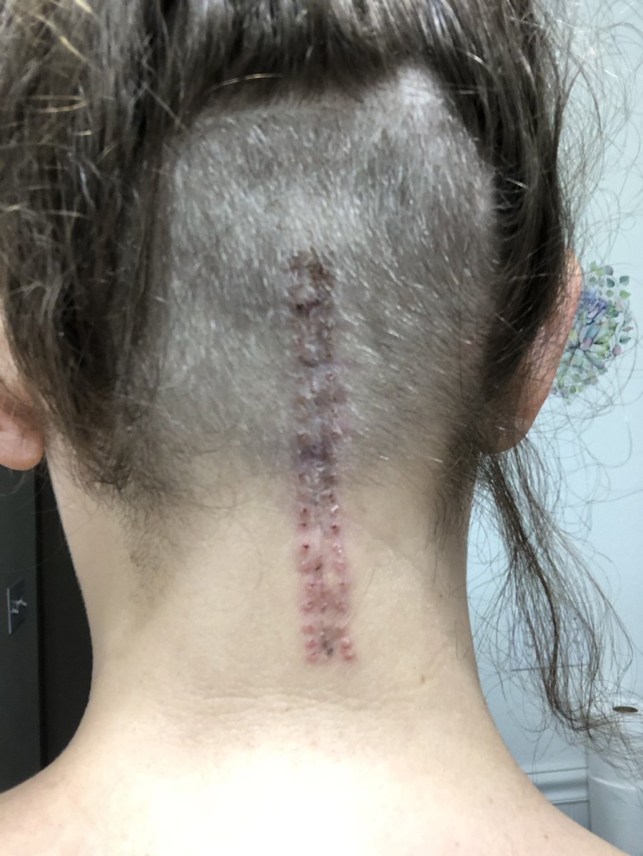 D_lightful_D's tweet photo. Recovery day 9: Got my staples removed today. Looking pretty good. Recovery still super slow. Lots of weakness and pain. Doctors says probably 3 more week until I’m up to par. #ChiariMalformation #DecompressionSurgery https://t.co/8JwuAF621C