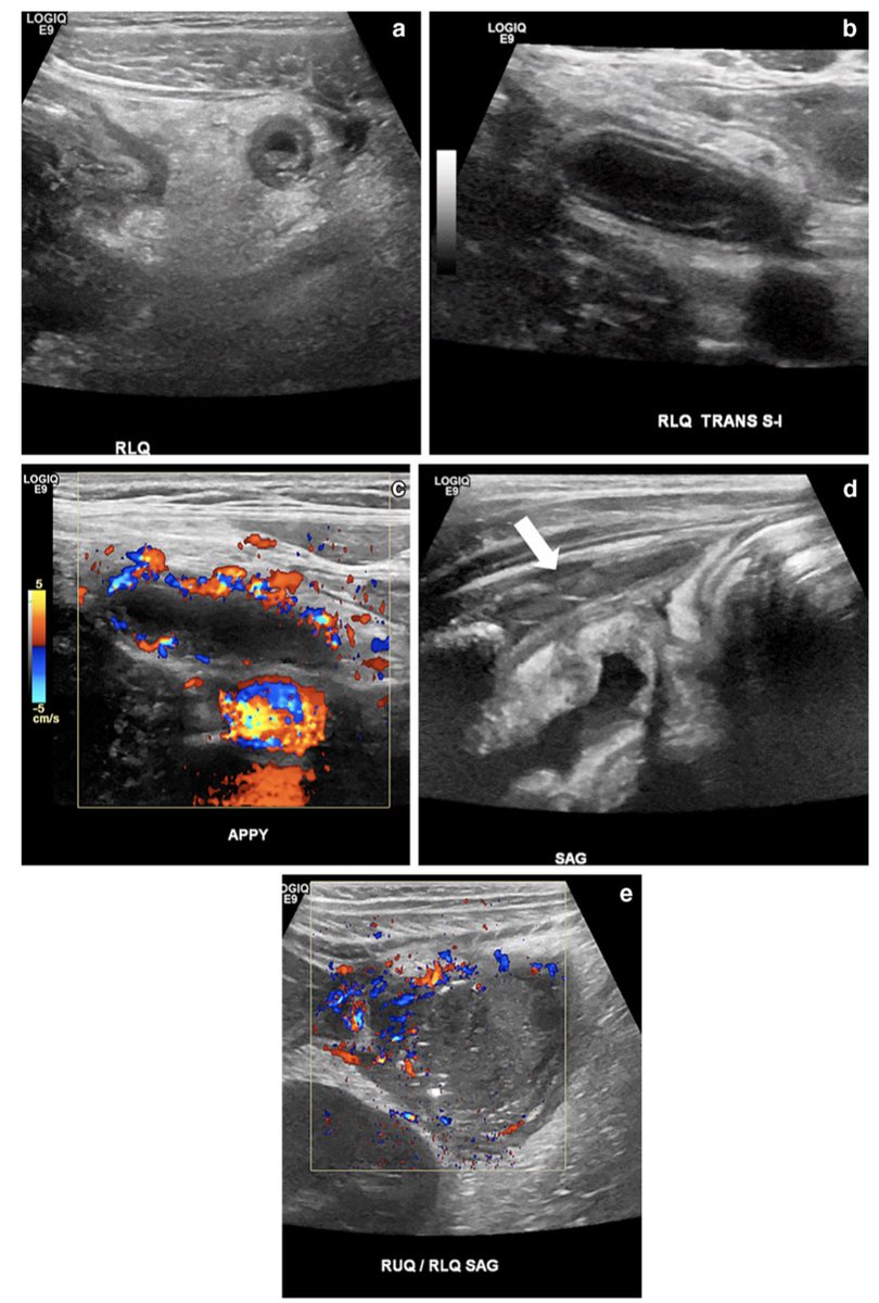 CirugiaPediaMx's tweet photo. Algunos de los hallazgos más sugestivos de apendicitis perforada encontrados por ultrasonido: 
#SoMe4pedSurg 👶🏻 https://t.co/geopmhWyPx