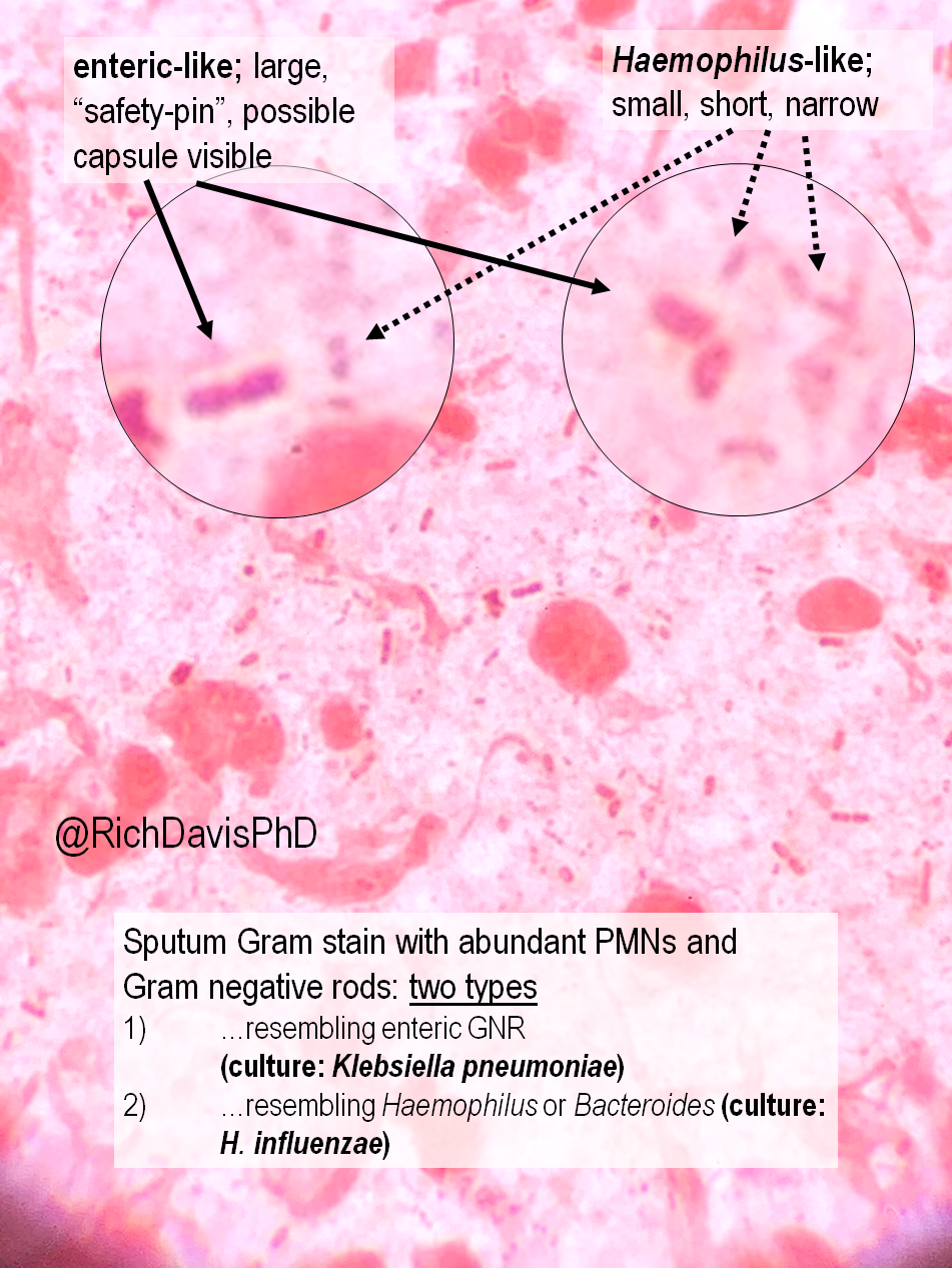 Rich Davis, PhD, D(ABMM), MLS🧫🦠 on X: "#MicroRounds (Day 701): Not all  Gram neg rods look alike. Sputum culture, grew two diff GNRs, classic  pathogens: Klebsiella pneumoniae and Haemophilus influenzae. Clear  morphology