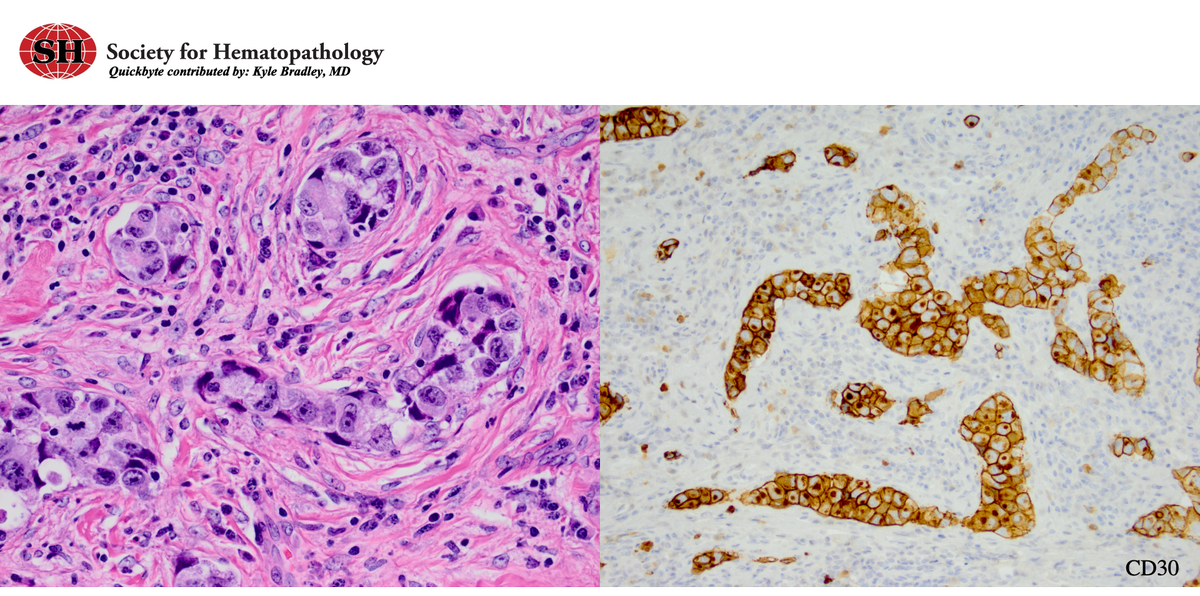 SocforHemepath's tweet photo. #SHQuickByte: Early lymph node involvement by anaplastic large cell lymphoma (ALCL) may be limited to the sinuses.
Typically, CD30 shows uniform strong staining of ALCL cells in a "rim and dot" (i.e. cell membrane and Golgi) pattern
#lymsm #pathology #hemepath https://t.co/TVuakowSxw