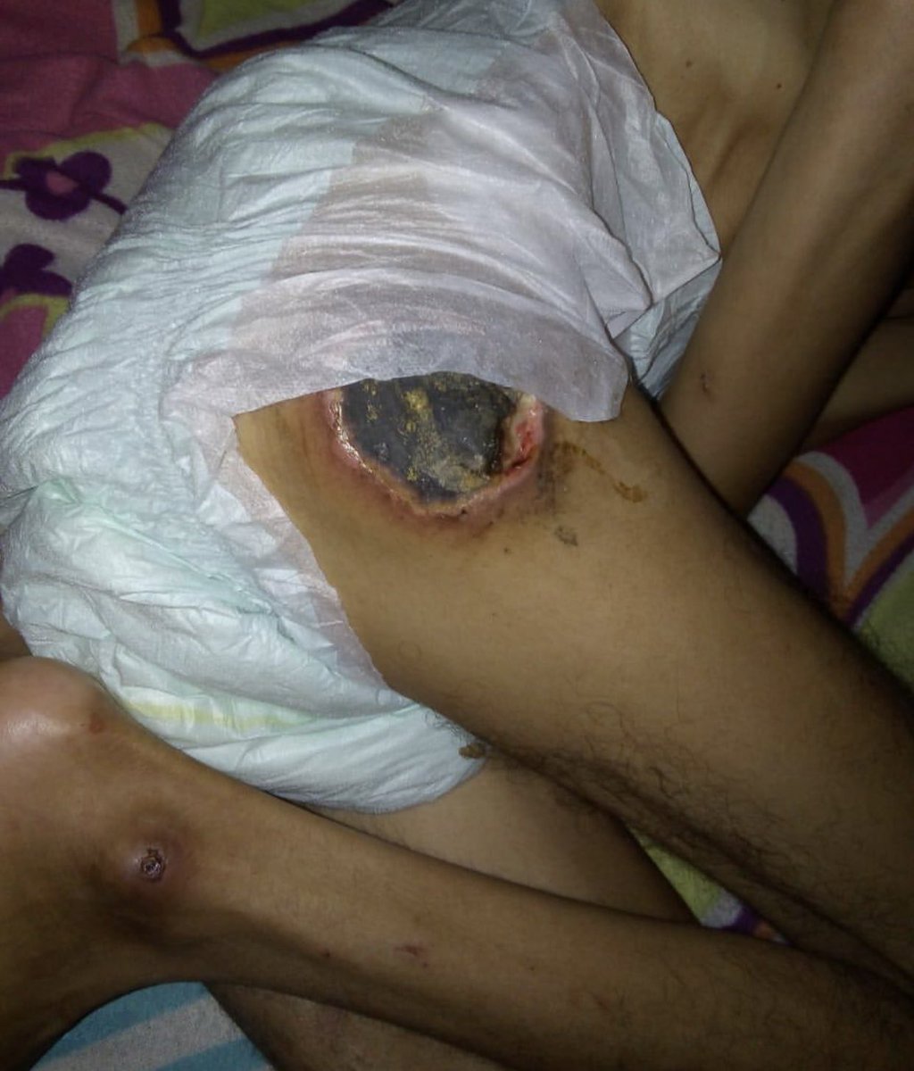 LaGeorgina's tweet photo. ⚠️ AYÚDENME CON UN RT ⚠️ y DONANDO ⚠️ Juan Carlos es  joven de 39 años de edad, pero el nacio con paralisis cerebral, nunca ha caminado, no habla, no tiene ningún tipo de movimiento por si solo, sus padres fallecieron, su mama hace 2 años. 🧵 ABRO HILO !!! https://t.co/3NVFyM83Hj