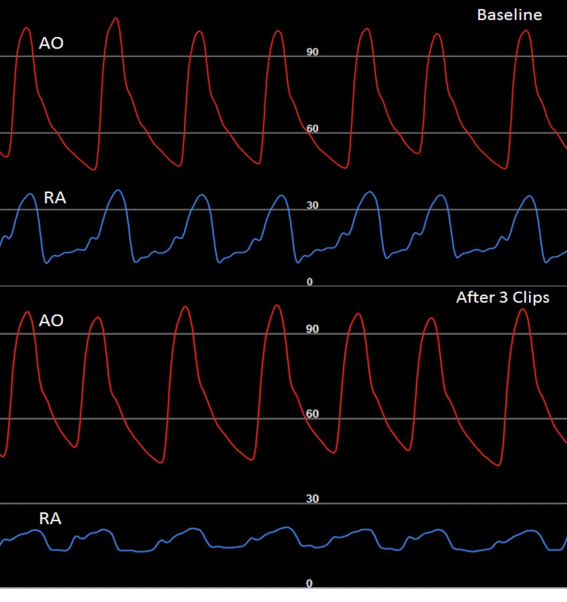 Mohamad Alkhouli (@adnanalkhouli) on Twitter photo Hemodynamic effects of reducing tricuspid regurgitation from torrential to mild-moderate with 3 MitraClip XTW. Pressure tracings recorded via the clip G4 guide. #tricuspid @SorinVPislaru @michelenahector <a href="/tjsimard/">Trevor Simard</a> <a href="/aelsab/">Abdallah El Sabbagh</a> <a href="/SEH_MD/">Stephanie El Hajj Younes MD</a> <a href="/kashishgoelmd/">Kashish Goel</a> @drpaulfriedman Hemodynamic effects of reducing tricuspid regurgitation from torrential to mild-moderate with 3 MitraClip XTW. Pressure tracings recorded via the clip G4 guide. #tricuspid @SorinVPislaru @michelenahector <a href="/tjsimard/">Trevor Simard</a> <a href="/aelsab/">Abdallah El Sabbagh</a> <a href="/SEH_MD/">Stephanie El Hajj Younes MD</a> <a href="/kashishgoelmd/">Kashish Goel</a> @drpaulfriedman