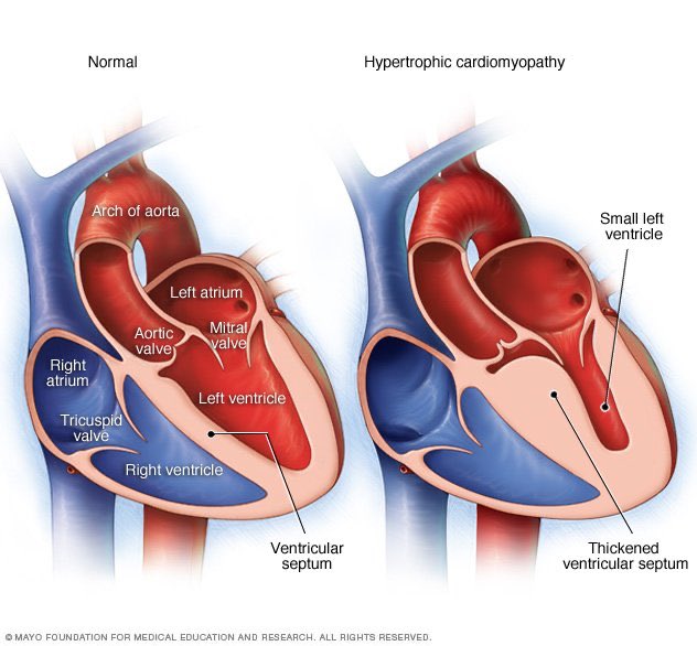 DrBeniRusani's tweet image. ❤️ Info:
You’ve heard young people (&amp;amp; celebrities) who died young in 30 - 40s. Fact: not all due to heart attack. Some are caused by genetic heart disease ‘Hypertropic cardiomyopathy’. Heart muscle thickens and interrupt blood flow exiting the heart; may cause sudden death.
