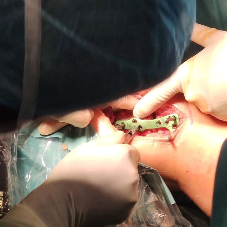 medcomtech_sa's tweet photo. En la Clinica CEMTRO de Madrid el Dr.Sanz y el Dr.Cortés han realizado una osteotomía de apertura lateral de fémur distal con guias PSI a una paciente de 40 años. Han utlizado una placa Activmotion de @newclip_gmbh @ClinicaCEMTRO
@medcomtech_sa @chuma1985 @DrSanzZapata https://t.co/UBKQas1vsu