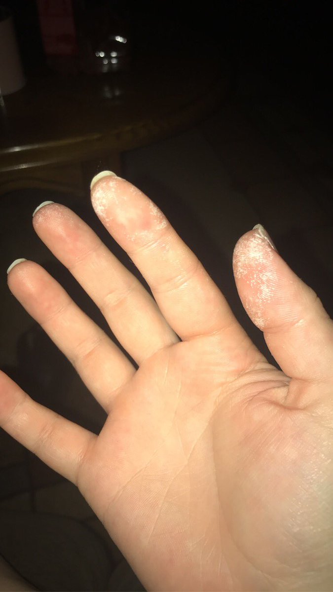 Fun Fact: you can be a dummy like me and burn your fingers with hair bleach and they will be temporarily white 🙄🙄 #weargloves 😂