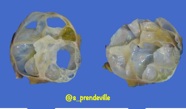 s_prendeville's tweet photo. Adult Cystic Nephroma 

🩺 F>M (7:1)
Currently classified as part of MEST tumour family (CN entirely cystic; MEST cystic and solid)

🔬Biphasic multicystic tumour: 
🔸Fibrous, often ovarian-type stroma: ER/PR +
🔸Cuboidal/hobnail cyst epithelial lining

#gupath #pathresidents https://t.co/ylNLECjt9D