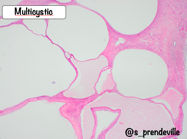 s_prendeville's tweet photo. Adult Cystic Nephroma 

🩺 F>M (7:1)
Currently classified as part of MEST tumour family (CN entirely cystic; MEST cystic and solid)

🔬Biphasic multicystic tumour: 
🔸Fibrous, often ovarian-type stroma: ER/PR +
🔸Cuboidal/hobnail cyst epithelial lining

#gupath #pathresidents https://t.co/ylNLECjt9D