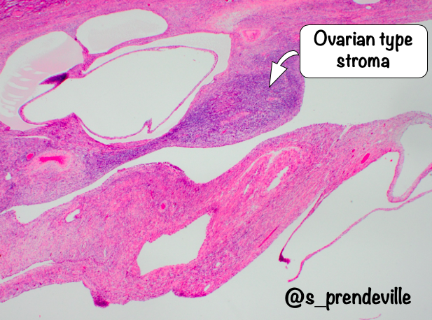 s_prendeville's tweet photo. Adult Cystic Nephroma 

🩺 F>M (7:1)
Currently classified as part of MEST tumour family (CN entirely cystic; MEST cystic and solid)

🔬Biphasic multicystic tumour: 
🔸Fibrous, often ovarian-type stroma: ER/PR +
🔸Cuboidal/hobnail cyst epithelial lining

#gupath #pathresidents https://t.co/ylNLECjt9D