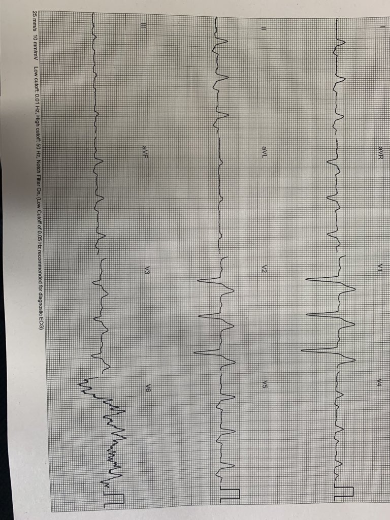 Mokhtar90481252's tweet photo. DCM, EF25%, NYHA 3, LBBB with no target for LV lead. I guess that’s better. #EPeeps #Hispacing https://t.co/gMw8WrcyX4