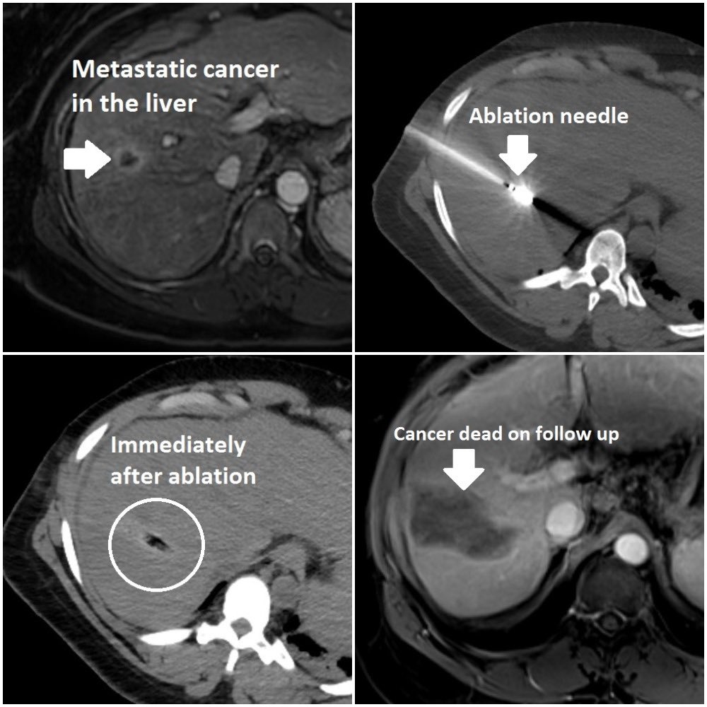 Interventional radiology (#IRad) can help control local sites of metastatic #cancer, helping keep patients off #chemotherapy. 

This #patient with ovarian cancer in the liver was treated by image-guided microwave ablation <a href="/uab_ir/">UAB IR</a>. 

Do you think we got it? #nocancerleftbehind