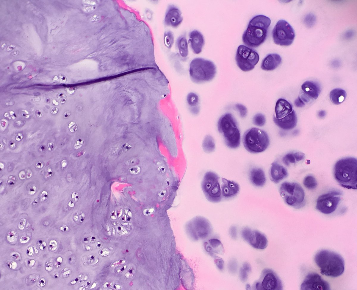 april_path's tweet image. A very photogenic tumor 😊
Chondrosarcoma (L) ot the cricoid cartilage (R).