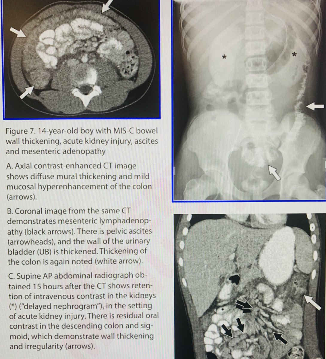 JudyYeeMD's tweet photo. Imaging findings in setting of #COVID19 can alert you to Multisystem Inflammatory Syndrome in Children prior to rapid deterioration. Research published @AJR_Radiology @MontefioreRAD @EinsteinMed @MontefioreNYC @EBlumfieldMD @LiszewskiMark https://t.co/bRPobwpgmf