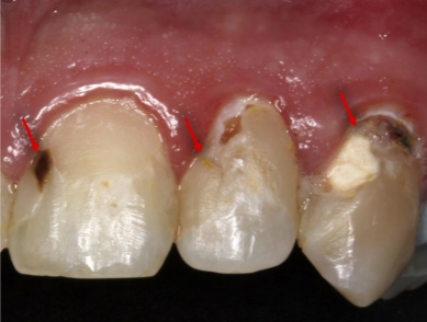 Future Use of Technology and Materials for Dental Restoration mdpi.com/si/37141 #mdpibioengineering via @MDPIOpenAccess Emerging Contact-Killing Antibacterial Strategies for Developing Anti-Biofilm Dental Polymeric Restorative Materials
@UMSOD_Dentistry @UMBGradSchool