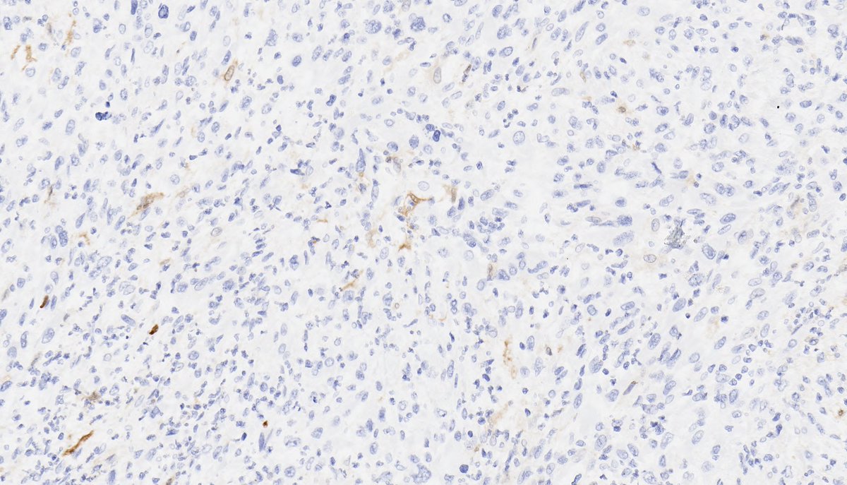 UNKNOWNS (2020.07.31). IHC: S100 (negative for: desmin, SMA, CD34, panCK). Hx: elderly patient with shoulder mass; no significant prior history.