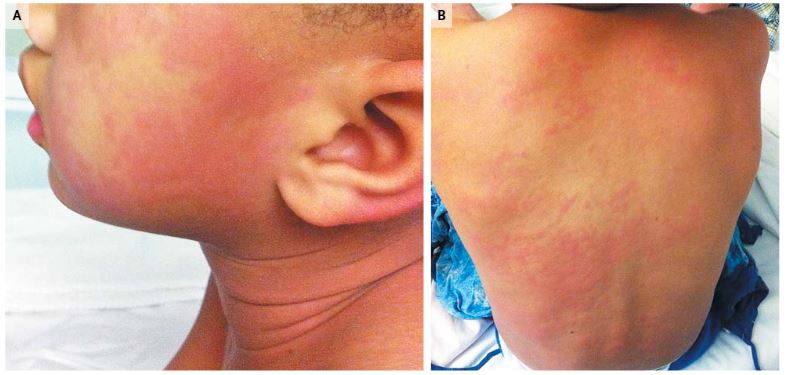 1/A 40F and her 10 yo son present with flushing of neck/face, headache, and diarrhea about 45 min after eating mackerel, rice, and some fruit (mango, cantaloupe). #IDTwitter  #IDMedEd  #MedTwitter  #FOAMed