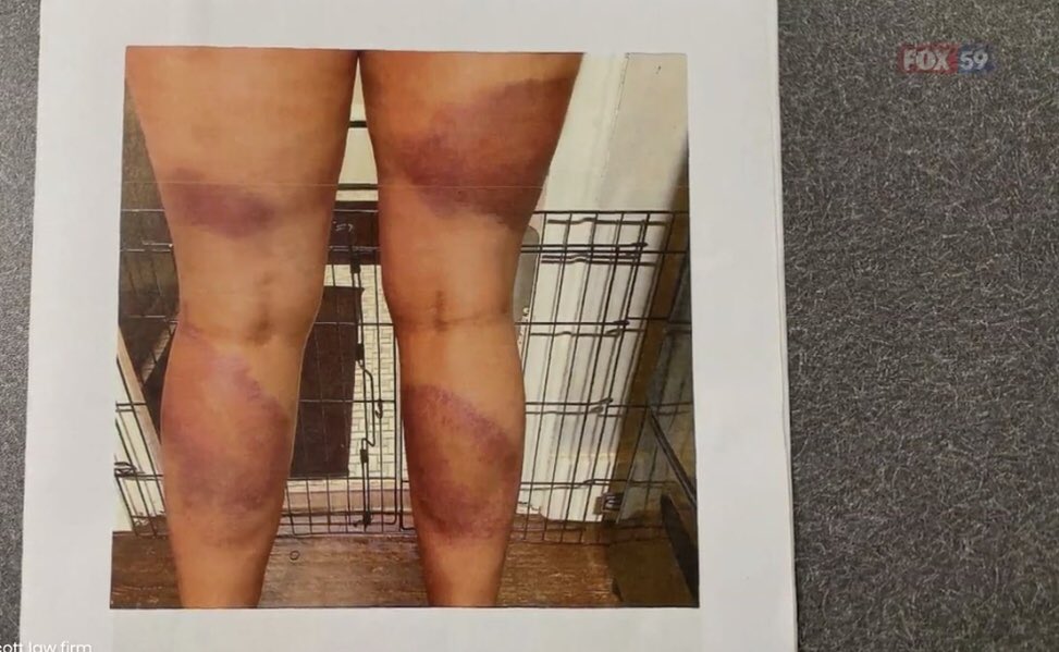indy_casey's tweet photo. Day 60. Week 9.
@IMPDnews @IMPD_Chief kudos to updating use-of-force policy.
Now, let’s talk about what happened 2 MONTHS ago when 4 officers beat 2 women. @IndyMayorJoe you talk of “accountability” but your silence speaks volumes. Pathetic. https://t.co/uCd025Stx3