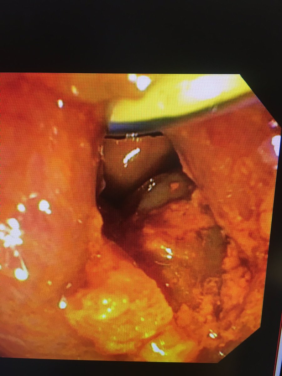 ChahalPrabhleen's tweet photo. @RodriguezParra_ @bisturitx @tberzin @jgarciacano1 @BrewerOlaya @sucovinti_ @AaronDiazMD @ZachSmithGI @KMonkemuller @EndoscopyOthman @almagoch @SanchezLunaMD @Ser_Sevill @mariasiribeiro @morenominilap1 @carolmangas @CarvalloP_MD @renzopc77 @mauriciorincons @MISIRG1 @mdjuanalcivar Spent 2.5 hrs yesterday on a stone case: RYGB/ MRI multiple large with two (2 cm, faceted) stones, hockey stick distal CBD/inflammatory stricture! 15 mm sohincteroplasty, burnt 3 EHL probes , close to 10,000shocks for a stone made of Granite !!  @RobertoSimonsMD https://t.co/erF7yZQcID