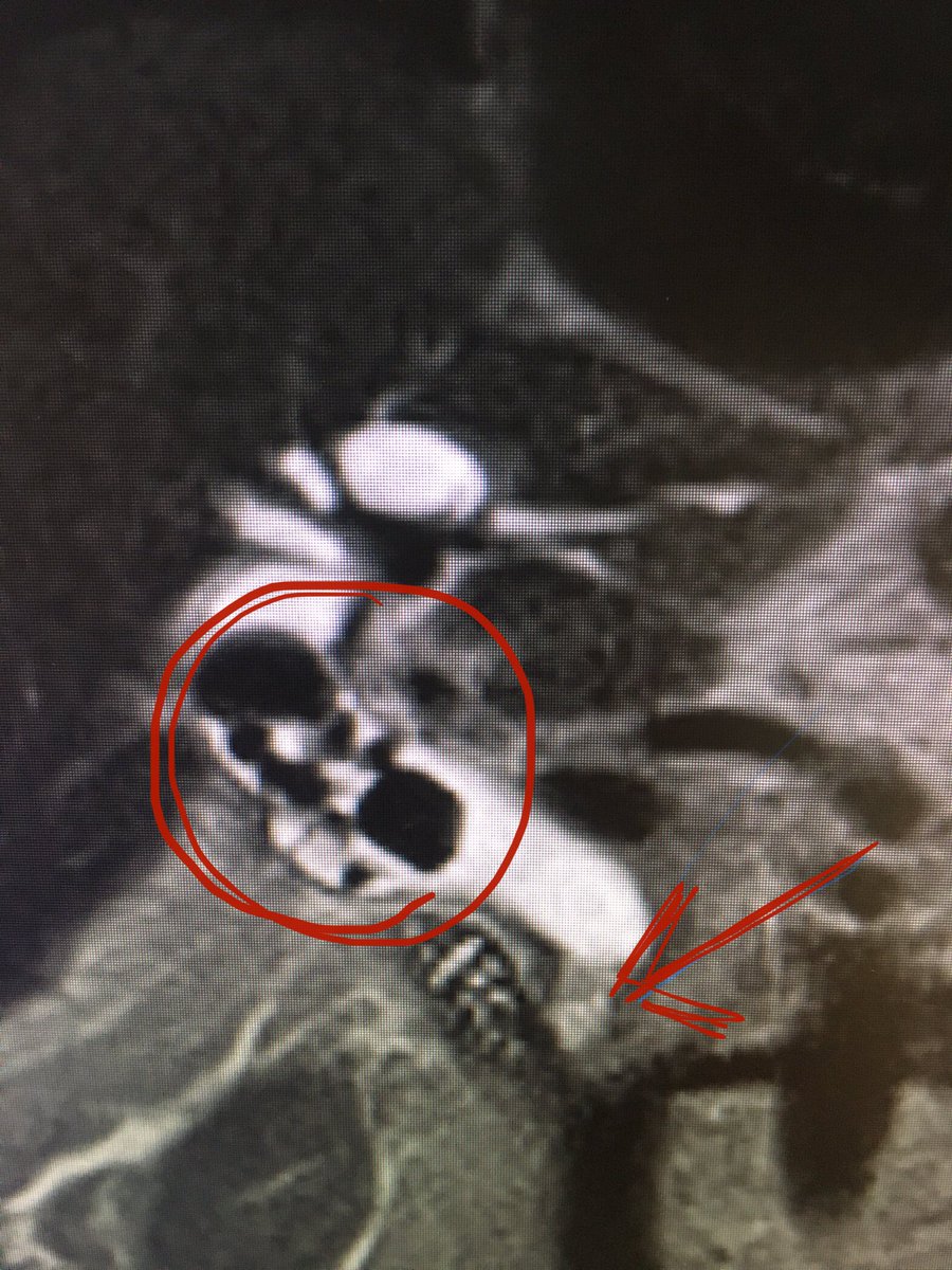 ChahalPrabhleen's tweet photo. @RodriguezParra_ @bisturitx @tberzin @jgarciacano1 @BrewerOlaya @sucovinti_ @AaronDiazMD @ZachSmithGI @KMonkemuller @EndoscopyOthman @almagoch @SanchezLunaMD @Ser_Sevill @mariasiribeiro @morenominilap1 @carolmangas @CarvalloP_MD @renzopc77 @mauriciorincons @MISIRG1 @mdjuanalcivar Spent 2.5 hrs yesterday on a stone case: RYGB/ MRI multiple large with two (2 cm, faceted) stones, hockey stick distal CBD/inflammatory stricture! 15 mm sohincteroplasty, burnt 3 EHL probes , close to 10,000shocks for a stone made of Granite !!  @RobertoSimonsMD https://t.co/erF7yZQcID