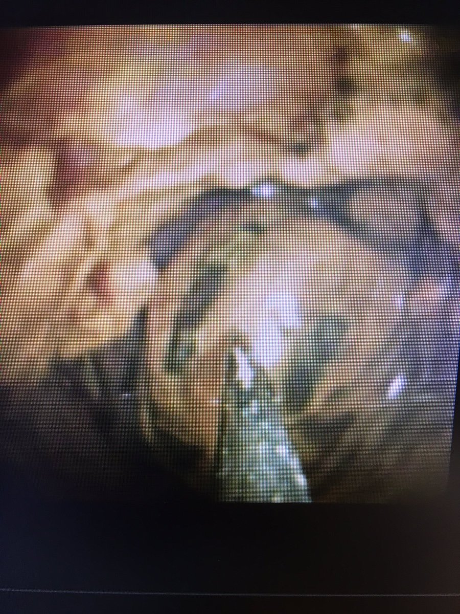 ChahalPrabhleen's tweet photo. @RodriguezParra_ @bisturitx @tberzin @jgarciacano1 @BrewerOlaya @sucovinti_ @AaronDiazMD @ZachSmithGI @KMonkemuller @EndoscopyOthman @almagoch @SanchezLunaMD @Ser_Sevill @mariasiribeiro @morenominilap1 @carolmangas @CarvalloP_MD @renzopc77 @mauriciorincons @MISIRG1 @mdjuanalcivar Spent 2.5 hrs yesterday on a stone case: RYGB/ MRI multiple large with two (2 cm, faceted) stones, hockey stick distal CBD/inflammatory stricture! 15 mm sohincteroplasty, burnt 3 EHL probes , close to 10,000shocks for a stone made of Granite !!  @RobertoSimonsMD https://t.co/erF7yZQcID