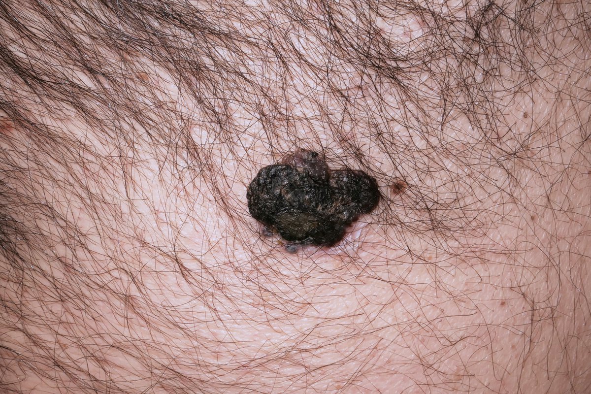 adr_diago's tweet photo. Ojo con las "queratosis seborreicas" y dediquémosles un poco de atención, que a veces pueden esconder melanomas tan gruesos como este https://t.co/YLUadYOFgo