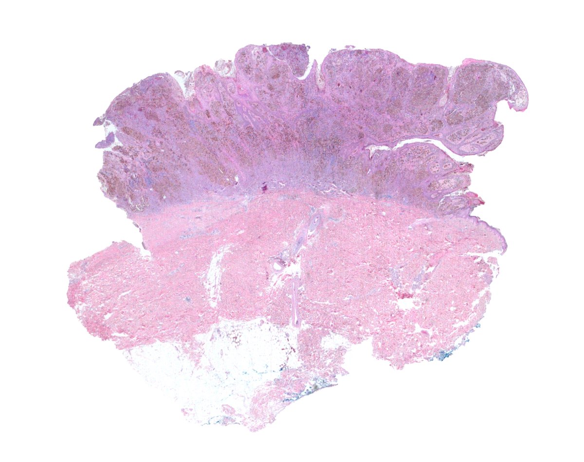 adr_diago's tweet photo. Ojo con las "queratosis seborreicas" y dediquémosles un poco de atención, que a veces pueden esconder melanomas tan gruesos como este https://t.co/YLUadYOFgo