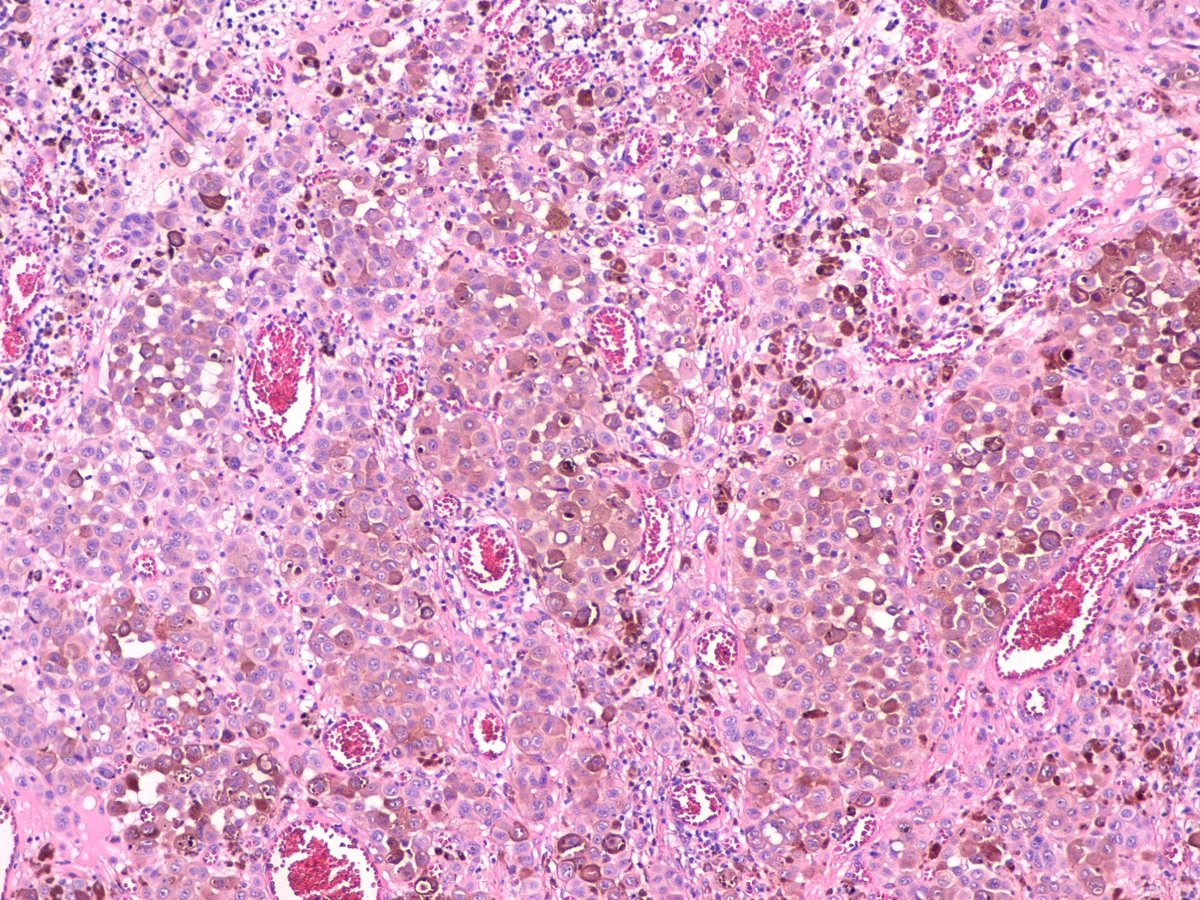 adr_diago's tweet photo. Ojo con las "queratosis seborreicas" y dediquémosles un poco de atención, que a veces pueden esconder melanomas tan gruesos como este https://t.co/YLUadYOFgo